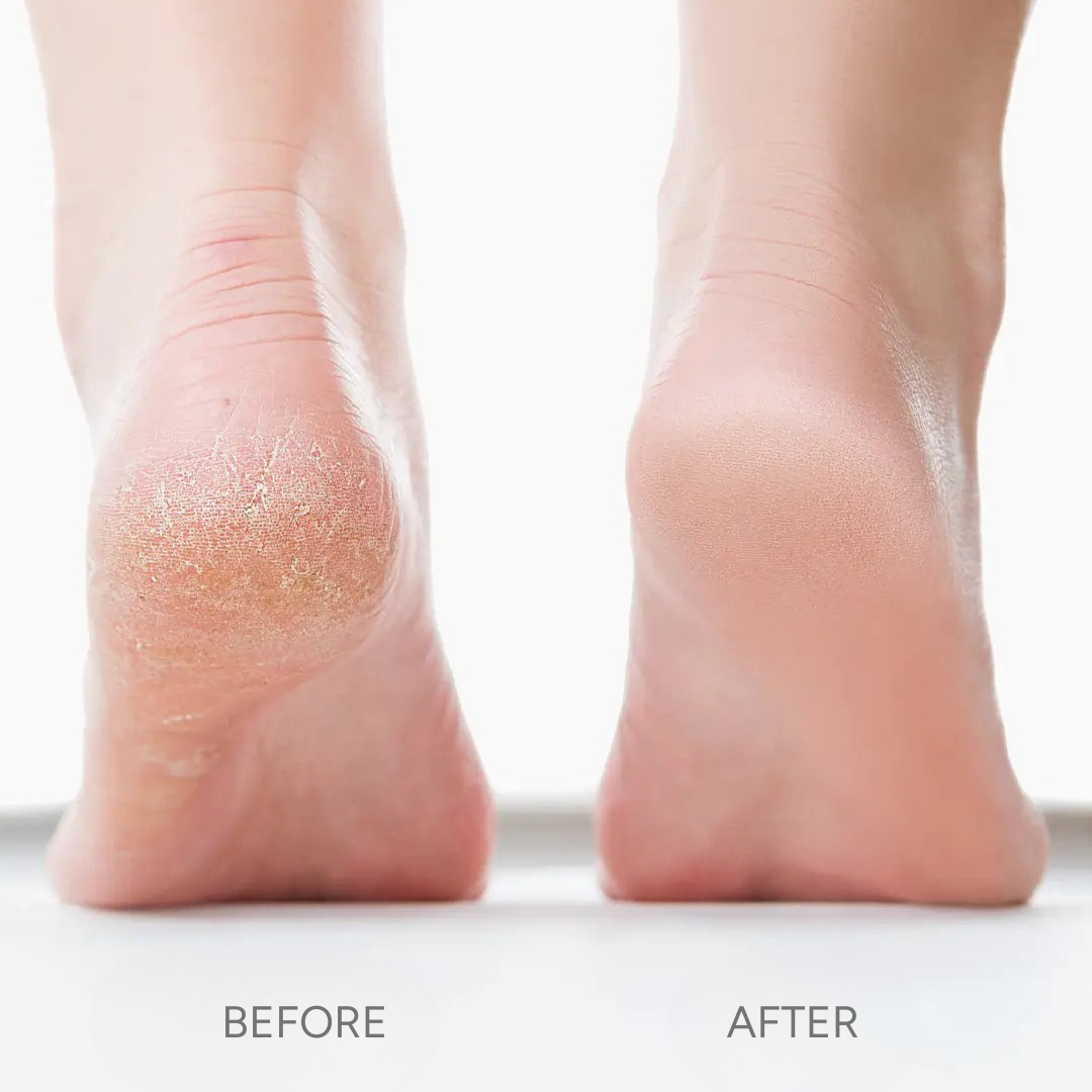 Azela Callus Remover 2.0