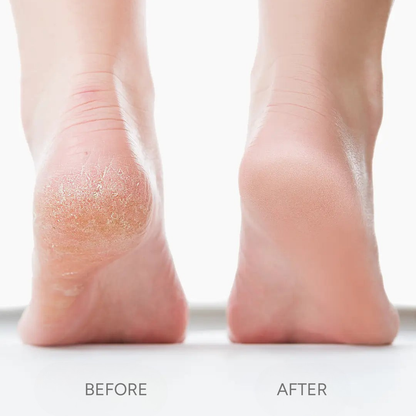 Azela Callus Remover 2.0